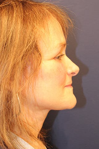 Brow Lift Before & After Gallery - Patient 174146382 - Image 6