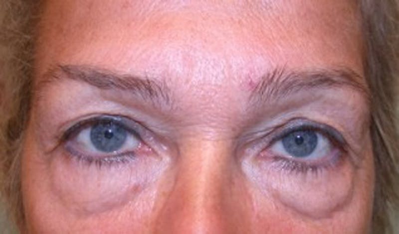 Brow Lift Before & After Gallery - Patient 174146384 - Image 1