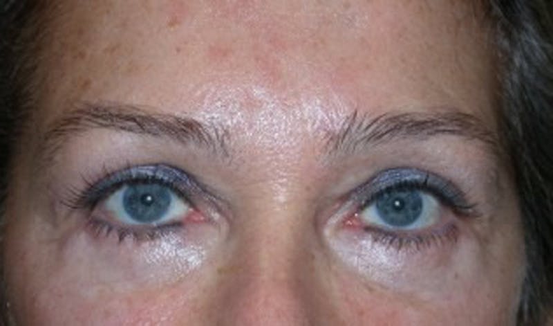Brow Lift Before & After Gallery - Patient 174146384 - Image 2