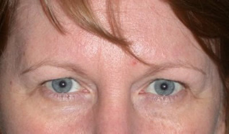 Brow Lift Before & After Gallery - Patient 174146385 - Image 1