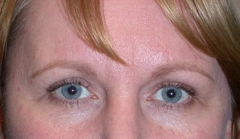 Brow Lift Before & After Gallery - Patient 174146385 - Image 2