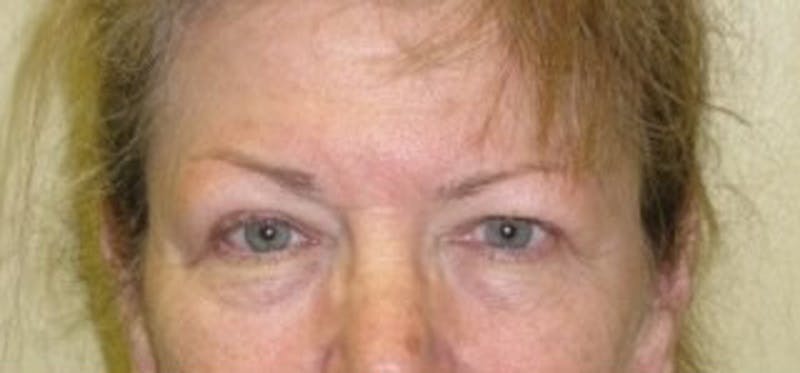 Brow Lift Before & After Gallery - Patient 174146386 - Image 1