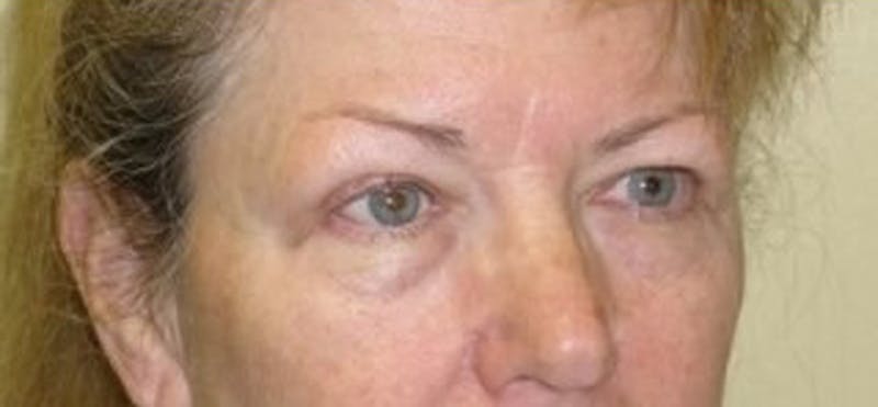 Brow Lift Before & After Gallery - Patient 174146386 - Image 3