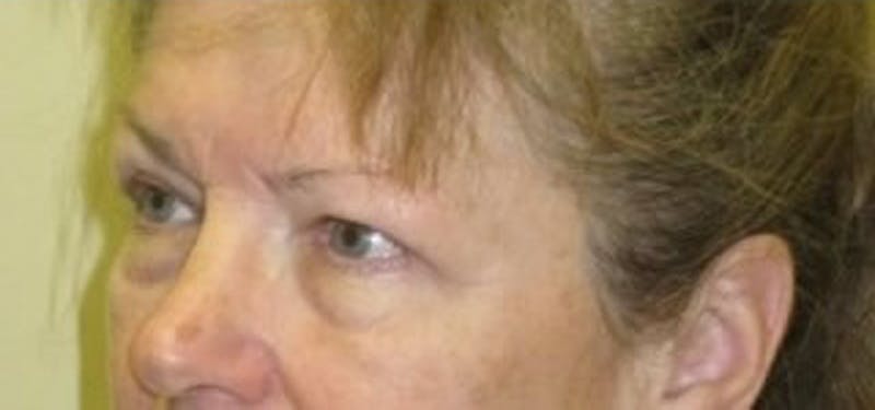 Brow Lift Before & After Gallery - Patient 174146386 - Image 5