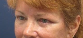 Brow Lift Before & After Gallery - Patient 174146386 - Image 6