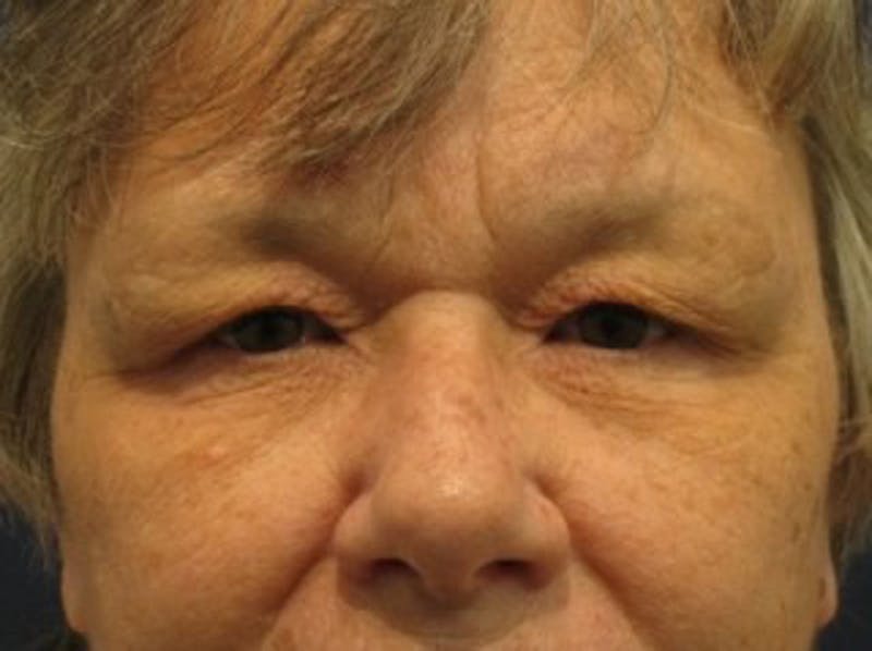 Brow Lift Before & After Gallery - Patient 174146388 - Image 1