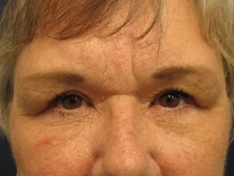 Brow Lift Before & After Gallery - Patient 174146388 - Image 2