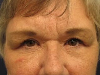 Brow Lift Before & After Gallery - Patient 174146388 - Image 2