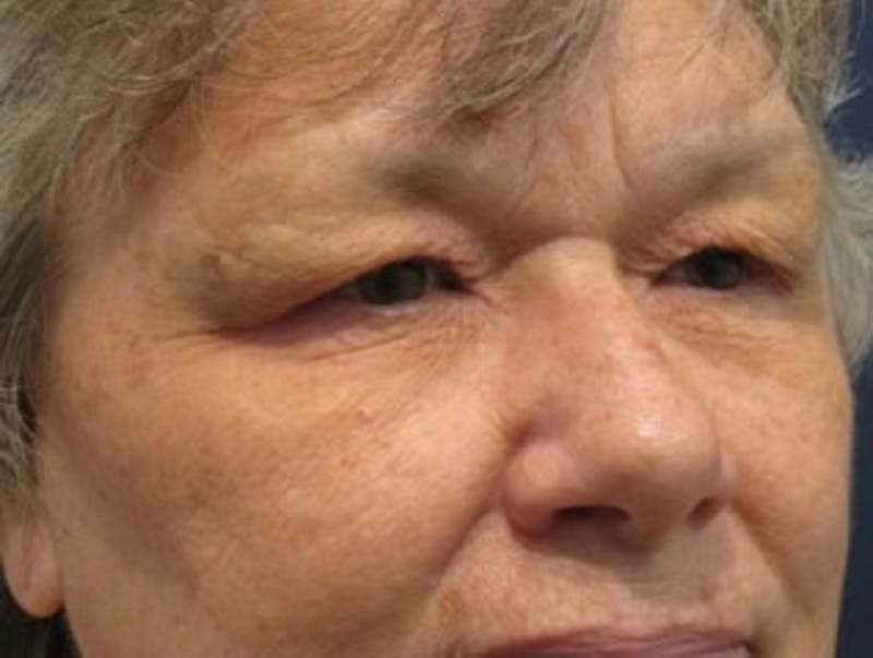 Brow Lift Before & After Gallery - Patient 174146388 - Image 5