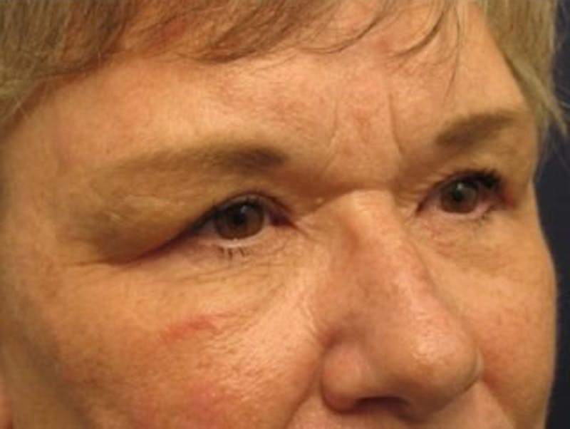 Brow Lift Before & After Gallery - Patient 174146388 - Image 6