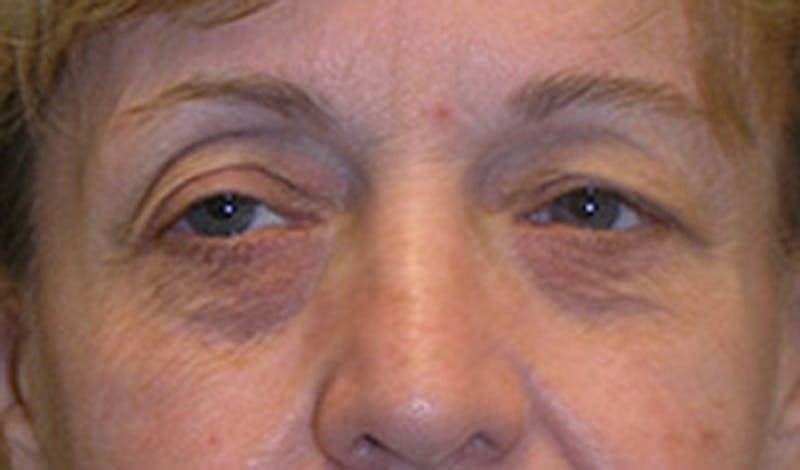 Brow Lift Before & After Gallery - Patient 174146389 - Image 1