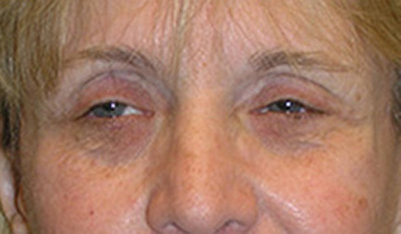 Brow Lift Before & After Gallery - Patient 174146389 - Image 2