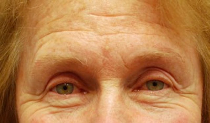 Brow Lift Before & After Gallery - Patient 174146391 - Image 1