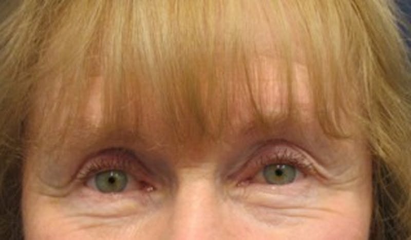 Brow Lift Before & After Gallery - Patient 174146391 - Image 2