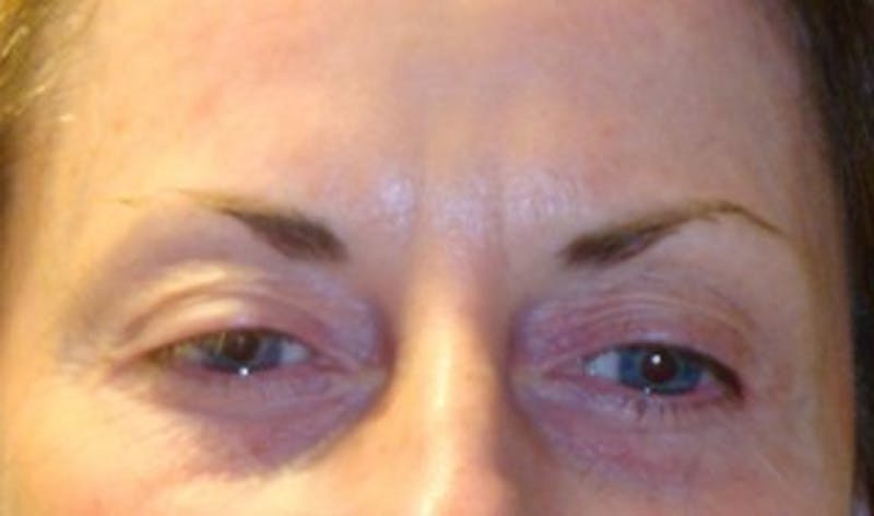 Brow Lift Before & After Gallery - Patient 174146392 - Image 1