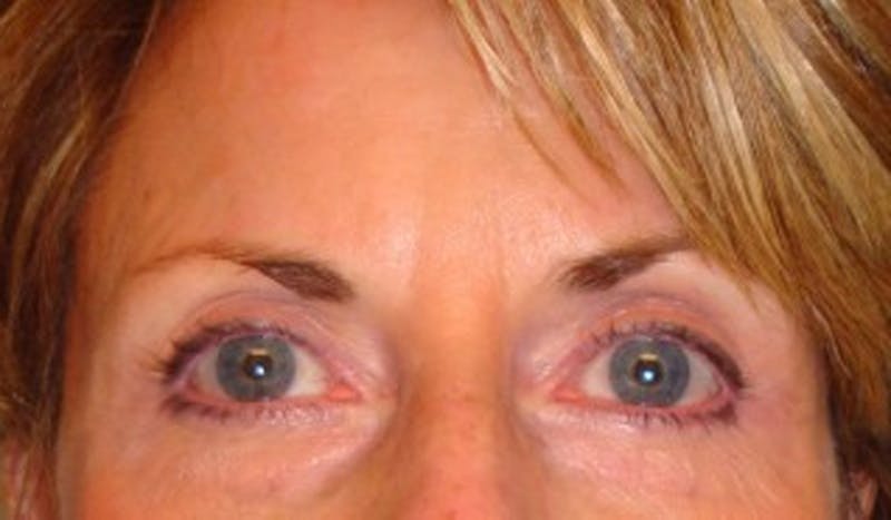 Brow Lift Before & After Gallery - Patient 174146392 - Image 2