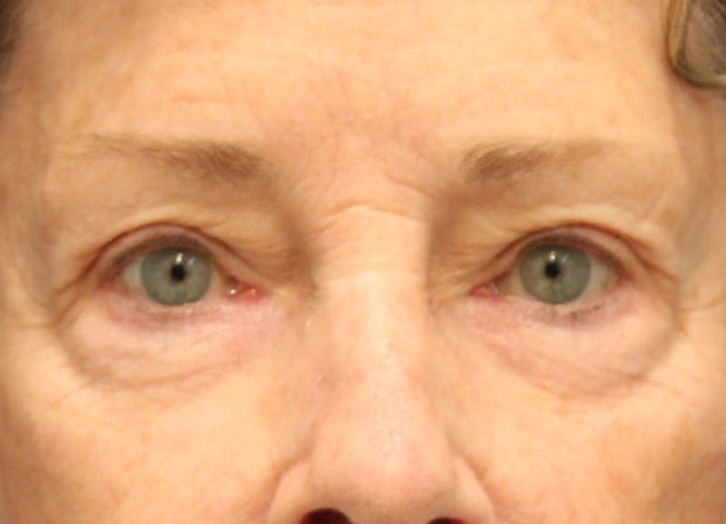 Eyelid Surgery Before & After Gallery - Patient 174146406 - Image 1