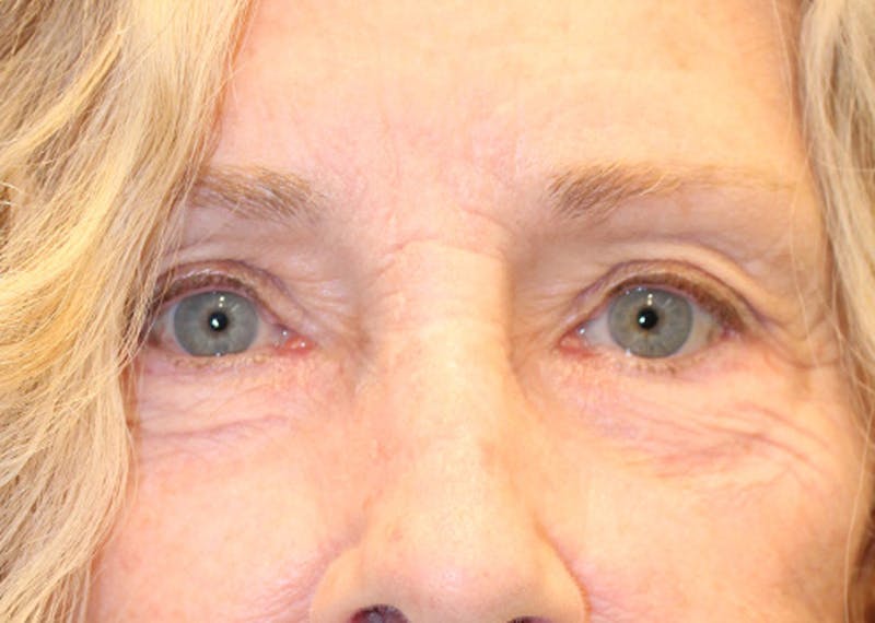 Eyelid Surgery Before & After Gallery - Patient 174146406 - Image 2