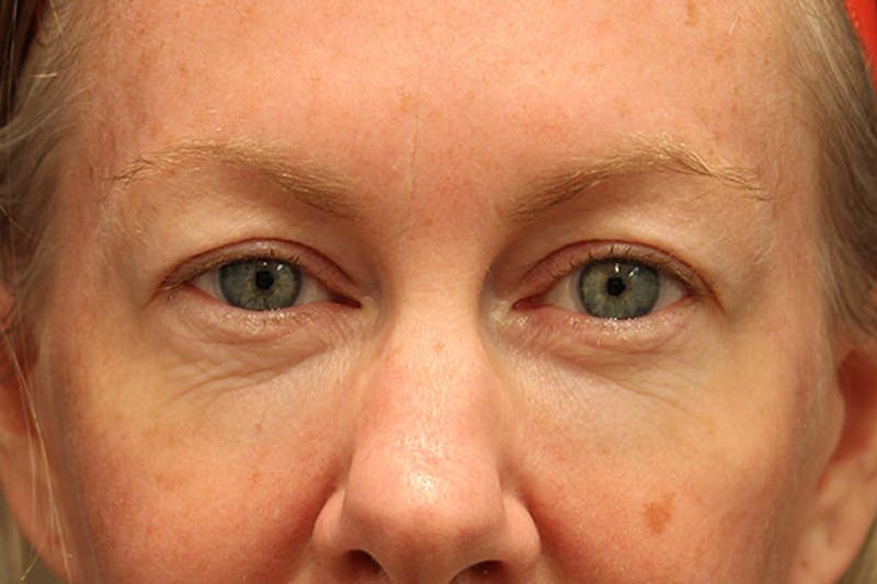 Eyelid Surgery Before & After Gallery - Patient 174146407 - Image 1
