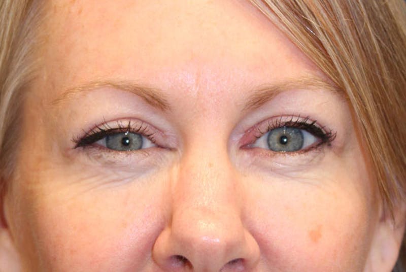 Eyelid Surgery Before & After Gallery - Patient 174146407 - Image 2