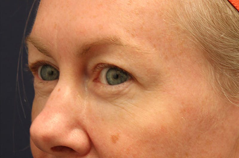 Eyelid Surgery Before & After Gallery - Patient 174146407 - Image 3