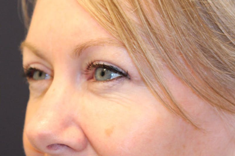 Eyelid Surgery Before & After Gallery - Patient 174146407 - Image 4