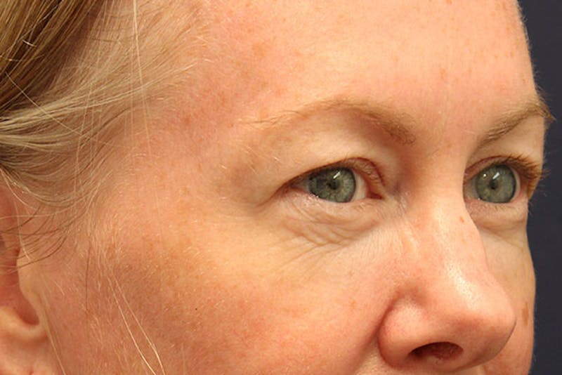 Eyelid Surgery Before & After Gallery - Patient 174146407 - Image 5