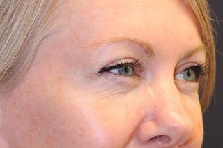 Eyelid Surgery Before & After Gallery - Patient 174146407 - Image 6