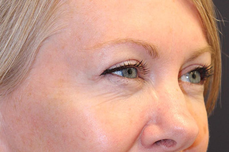 Eyelid Surgery Before & After Gallery - Patient 174146407 - Image 6