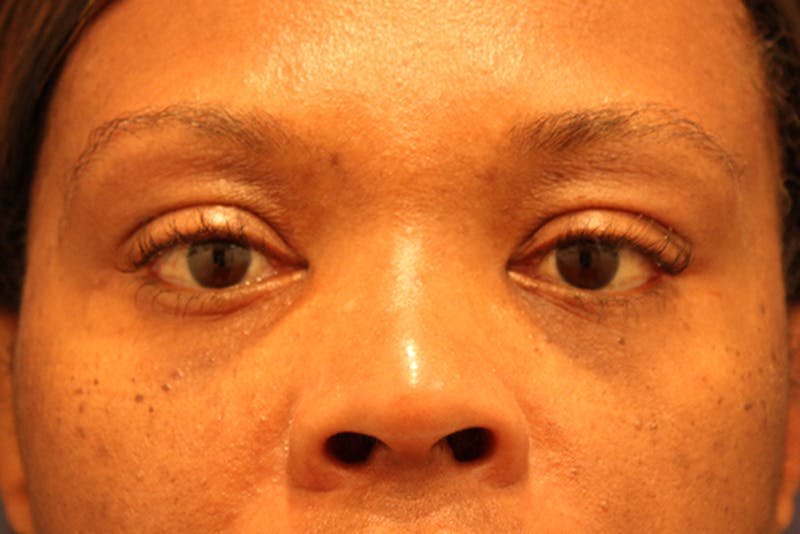 Eyelid Surgery Before & After Gallery - Patient 174146408 - Image 2