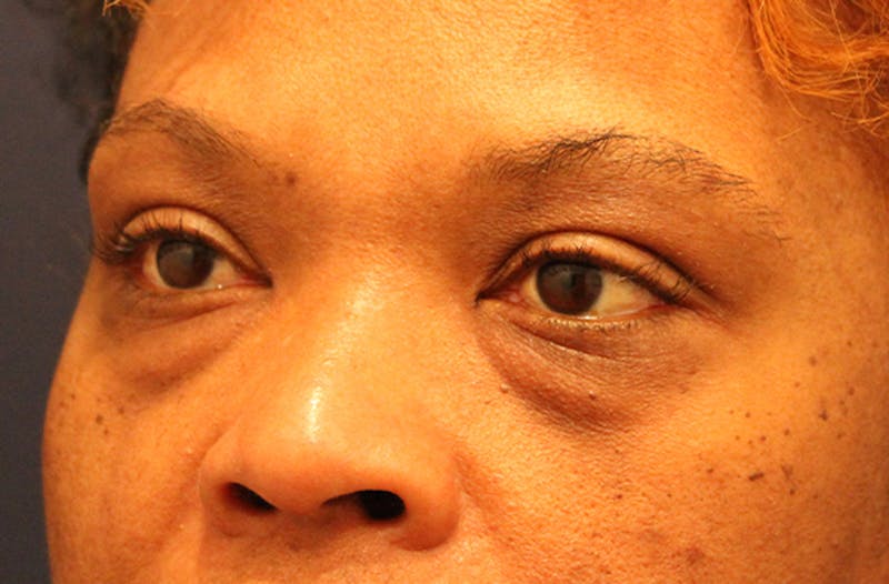 Eyelid Surgery Before & After Gallery - Patient 174146408 - Image 3