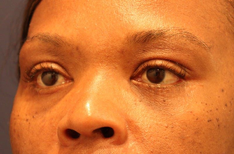 Eyelid Surgery Before & After Gallery - Patient 174146408 - Image 4