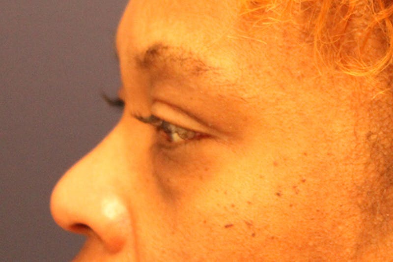 Eyelid Surgery Before & After Gallery - Patient 174146408 - Image 5