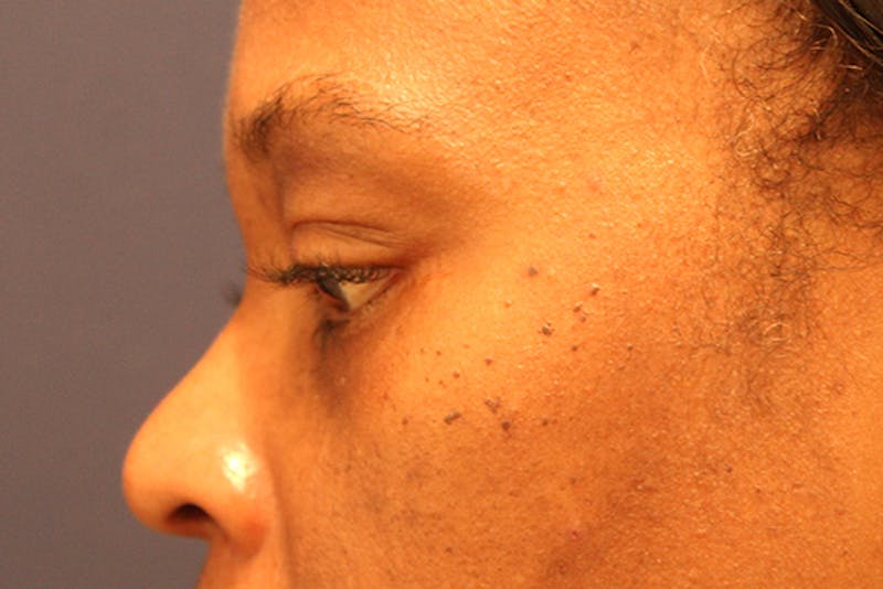 Eyelid Surgery Before & After Gallery - Patient 174146408 - Image 6