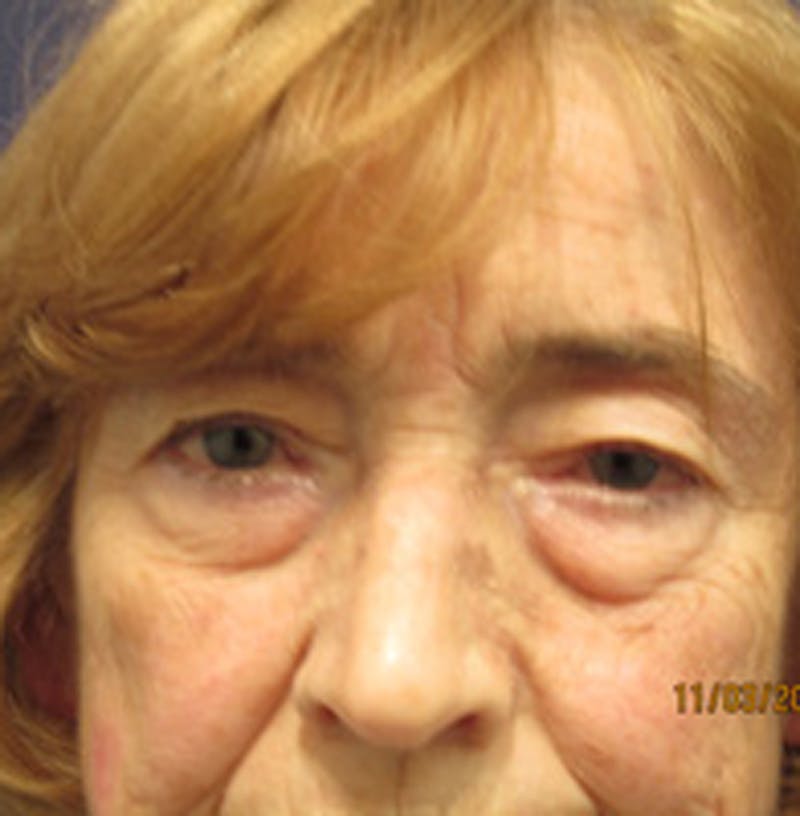 Eyelid Surgery Before & After Gallery - Patient 174146410 - Image 1