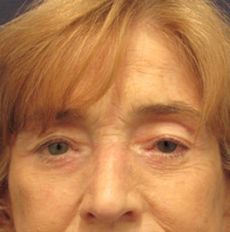 Eyelid Surgery Before & After Gallery - Patient 174146410 - Image 2