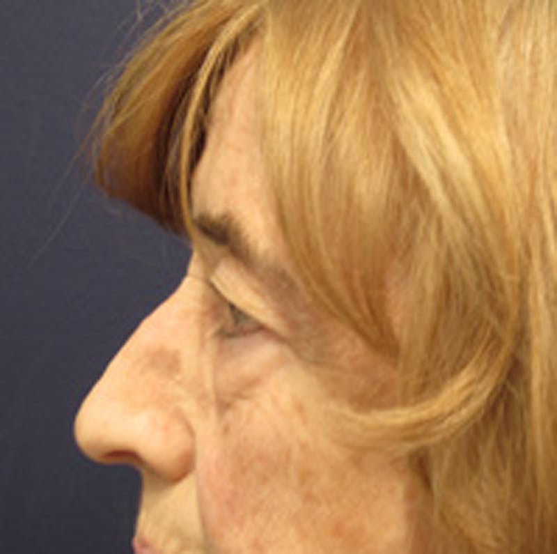 Eyelid Surgery Before & After Gallery - Patient 174146410 - Image 3