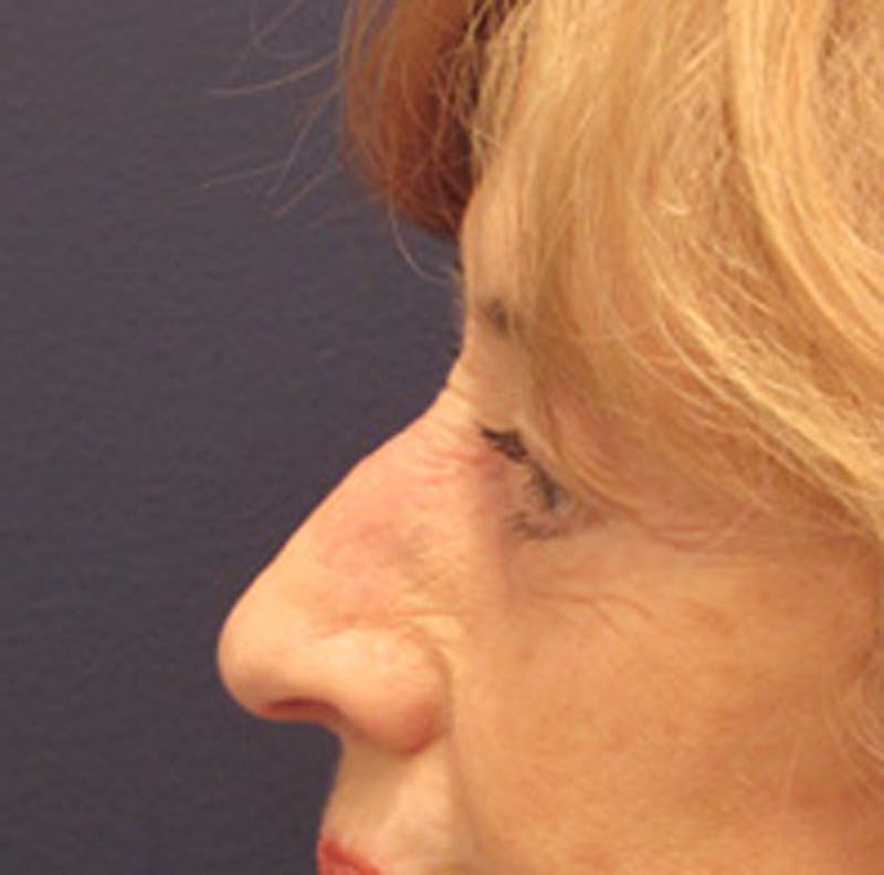 Eyelid Surgery Before & After Gallery - Patient 174146410 - Image 4