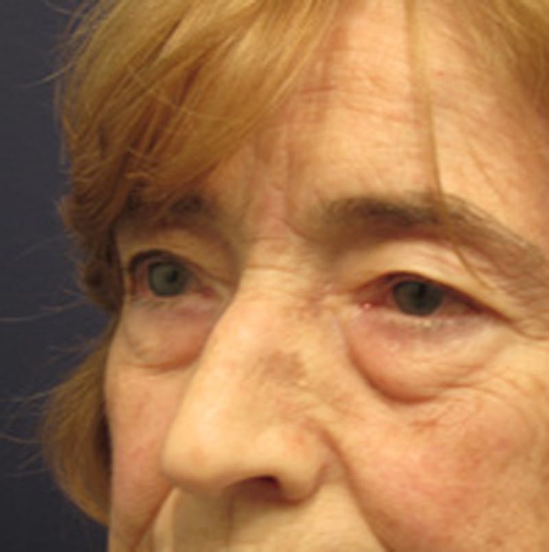 Eyelid Surgery Before & After Gallery - Patient 174146410 - Image 5