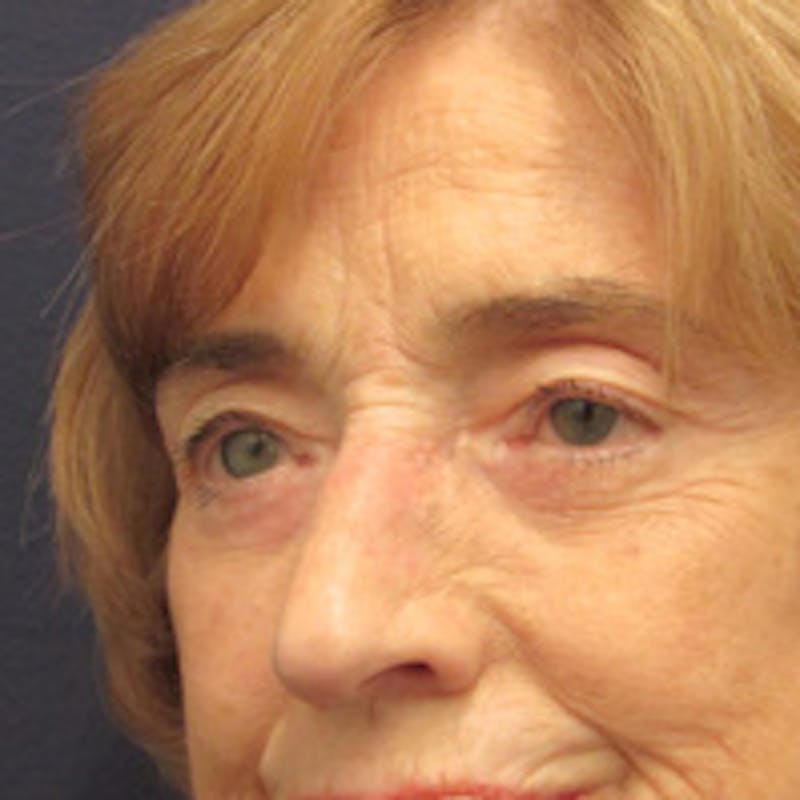 Eyelid Surgery Before & After Gallery - Patient 174146410 - Image 6