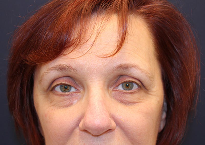 Eyelid Surgery Before & After Gallery - Patient 174146411 - Image 1