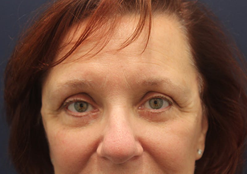 Eyelid Surgery Before & After Gallery - Patient 174146411 - Image 2