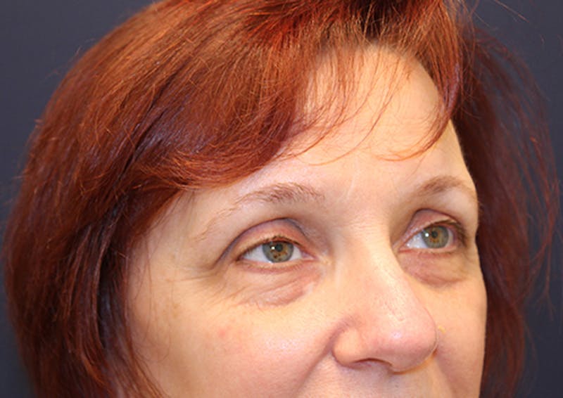 Eyelid Surgery Before & After Gallery - Patient 174146411 - Image 3