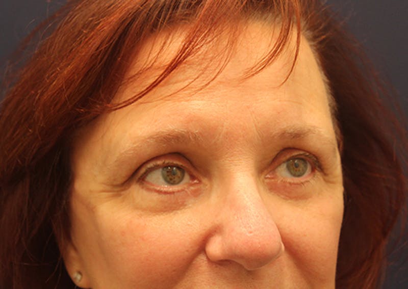 Eyelid Surgery Before & After Gallery - Patient 174146411 - Image 4