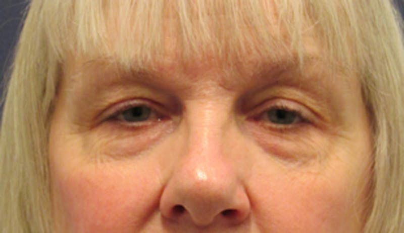 Eyelid Surgery Before & After Gallery - Patient 174146412 - Image 1