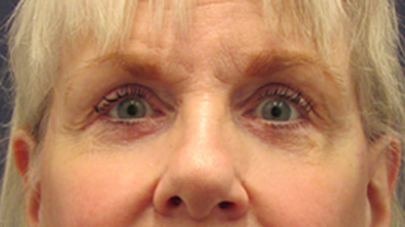 Eyelid Surgery Before & After Gallery - Patient 174146412 - Image 2
