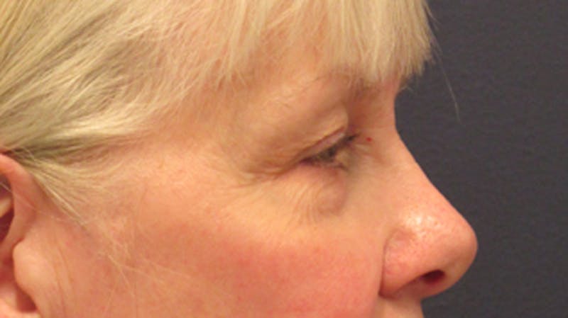 Eyelid Surgery Before & After Gallery - Patient 174146412 - Image 3
