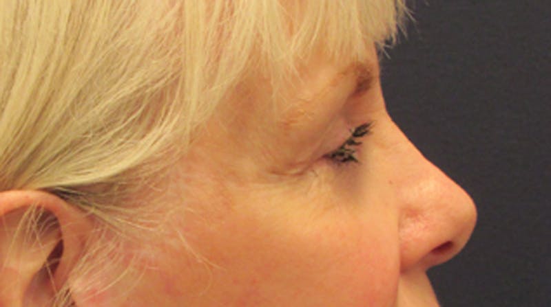 Eyelid Surgery Before & After Gallery - Patient 174146412 - Image 4