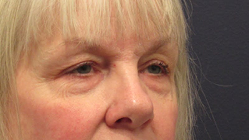 Eyelid Surgery Before & After Gallery - Patient 174146412 - Image 5