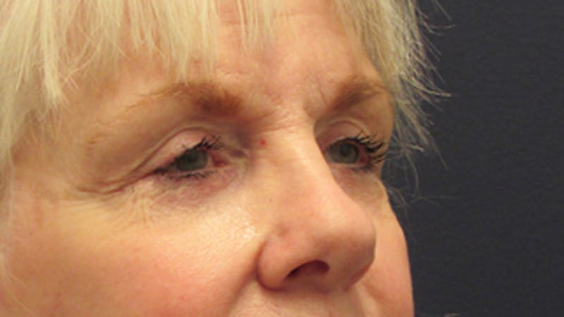 Eyelid Surgery Before & After Gallery - Patient 174146412 - Image 6